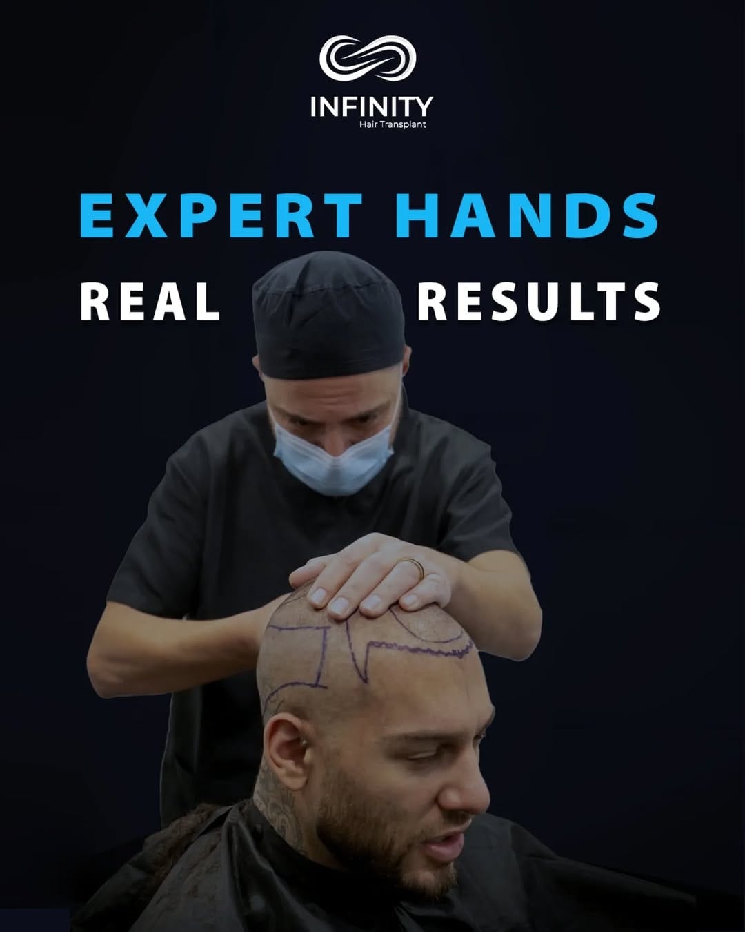 Post 1 by INFINITY hair transplant on Instagram (image)