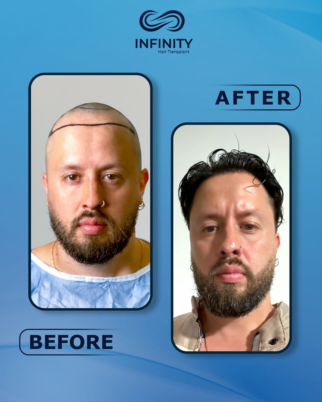 Post 6 by INFINITY hair transplant on Instagram (image)