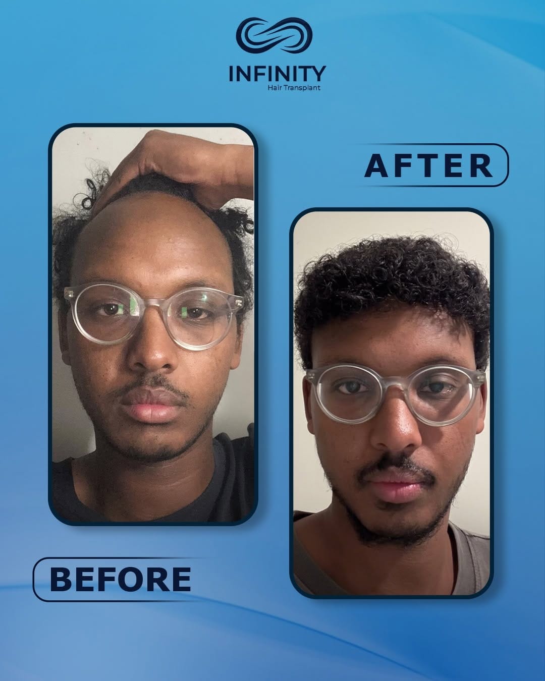 Post 4 by INFINITY hair transplant on Instagram (image)