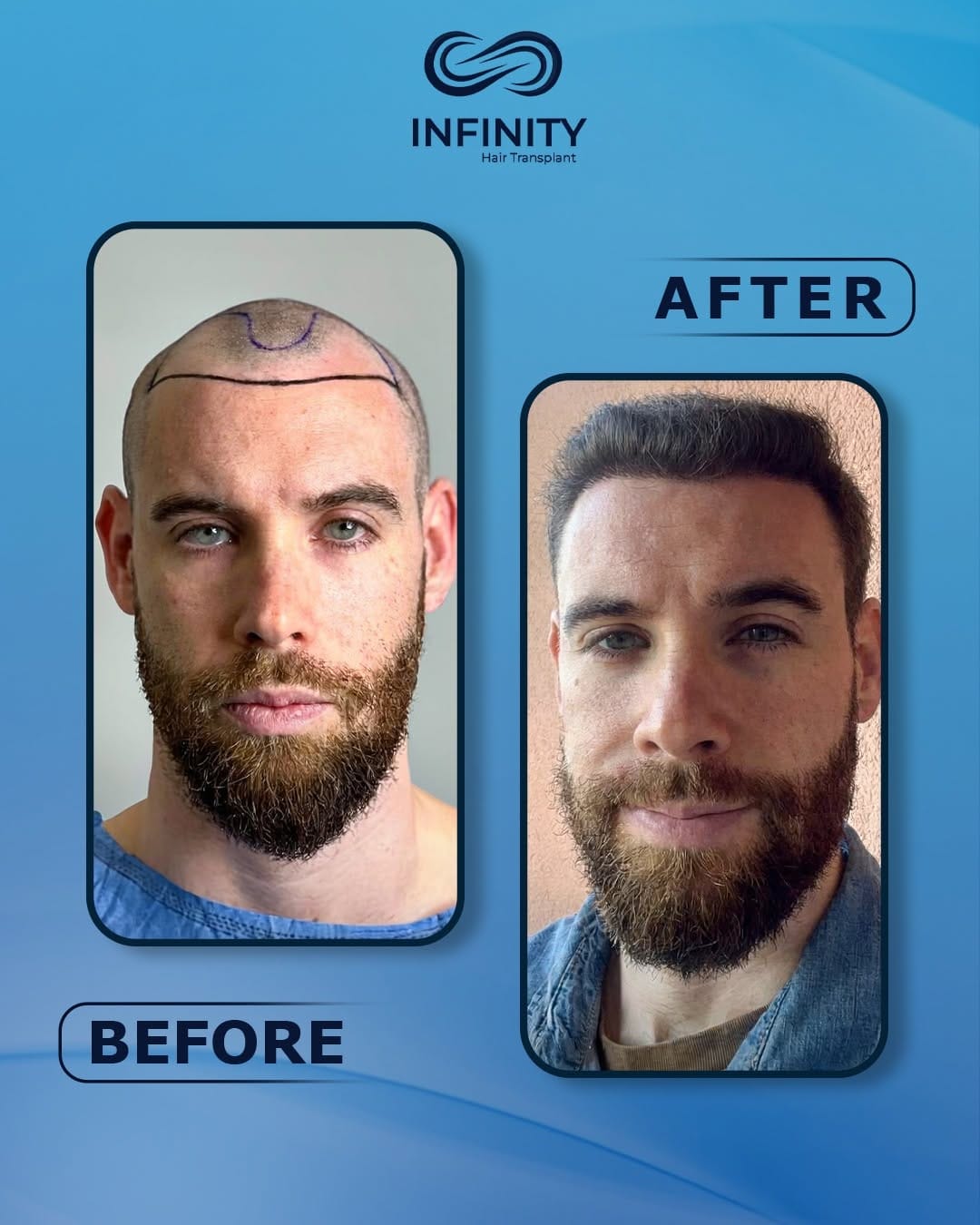 Post 5 by INFINITY hair transplant on Instagram (image)