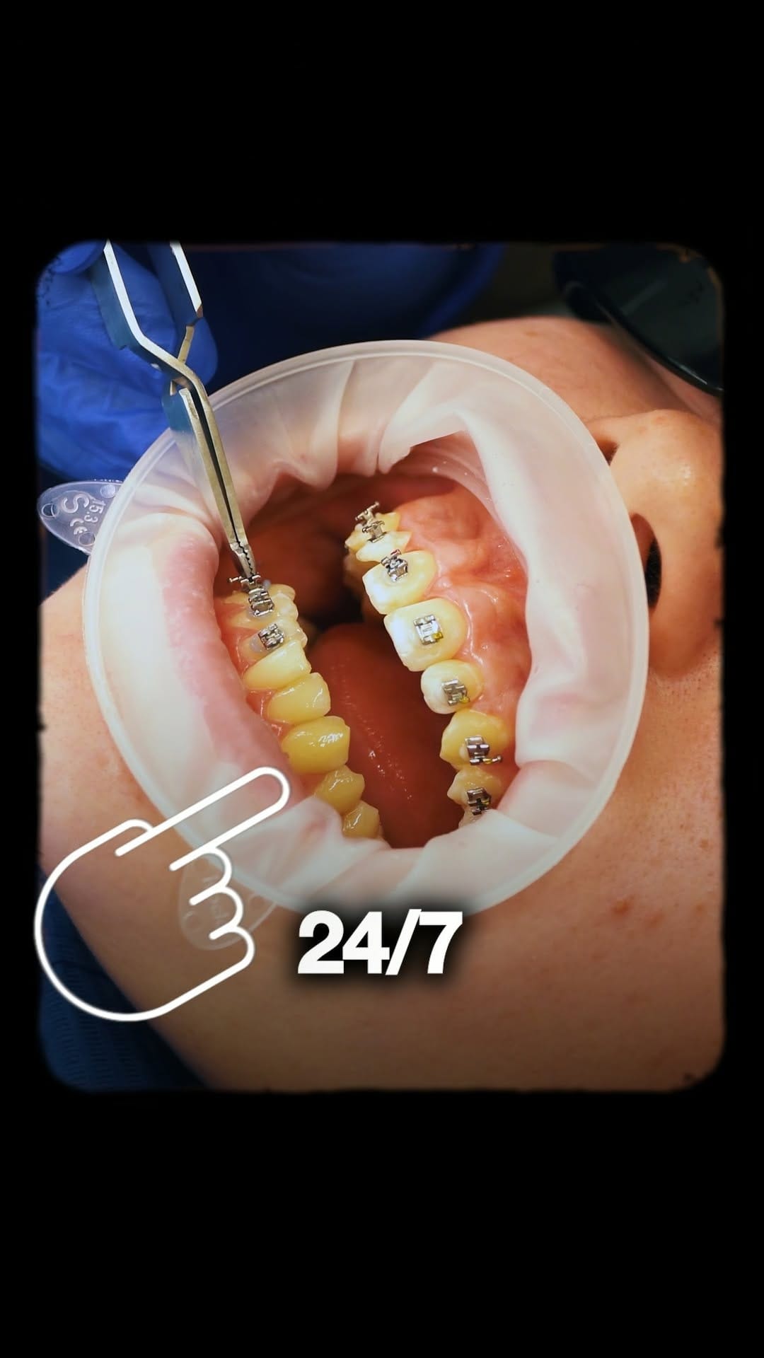 Post 9 by Dental Beauty on Instagram (video)