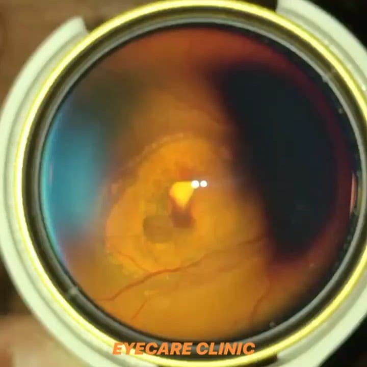 Post 8 by EYE CARE CLINIC on Instagram (video)