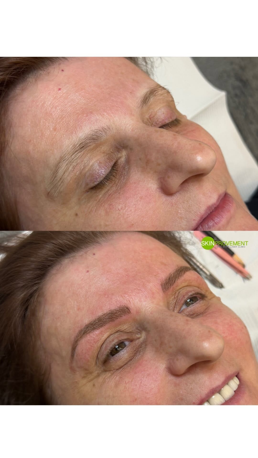 Post 5 by Skinprovement Medi Spa & Laser Clinic on Instagram (video)