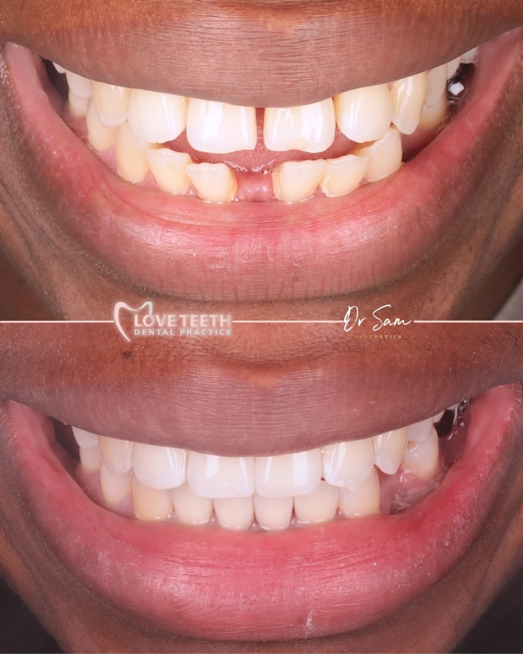 Post 5 by Invisalign • Veneers • Implants • Bonding on Instagram (carousel)