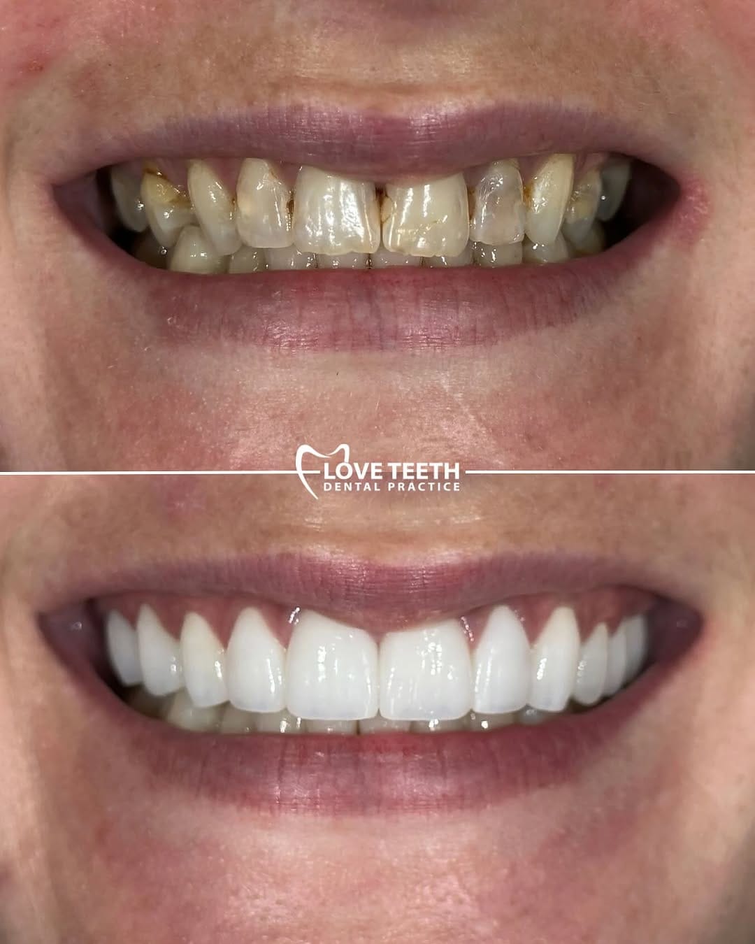 Post 10 by Invisalign • Veneers • Implants • Bonding on Instagram (image)