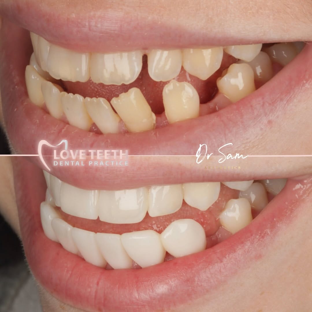 Post 3 by Invisalign • Veneers • Implants • Bonding on Instagram (carousel)