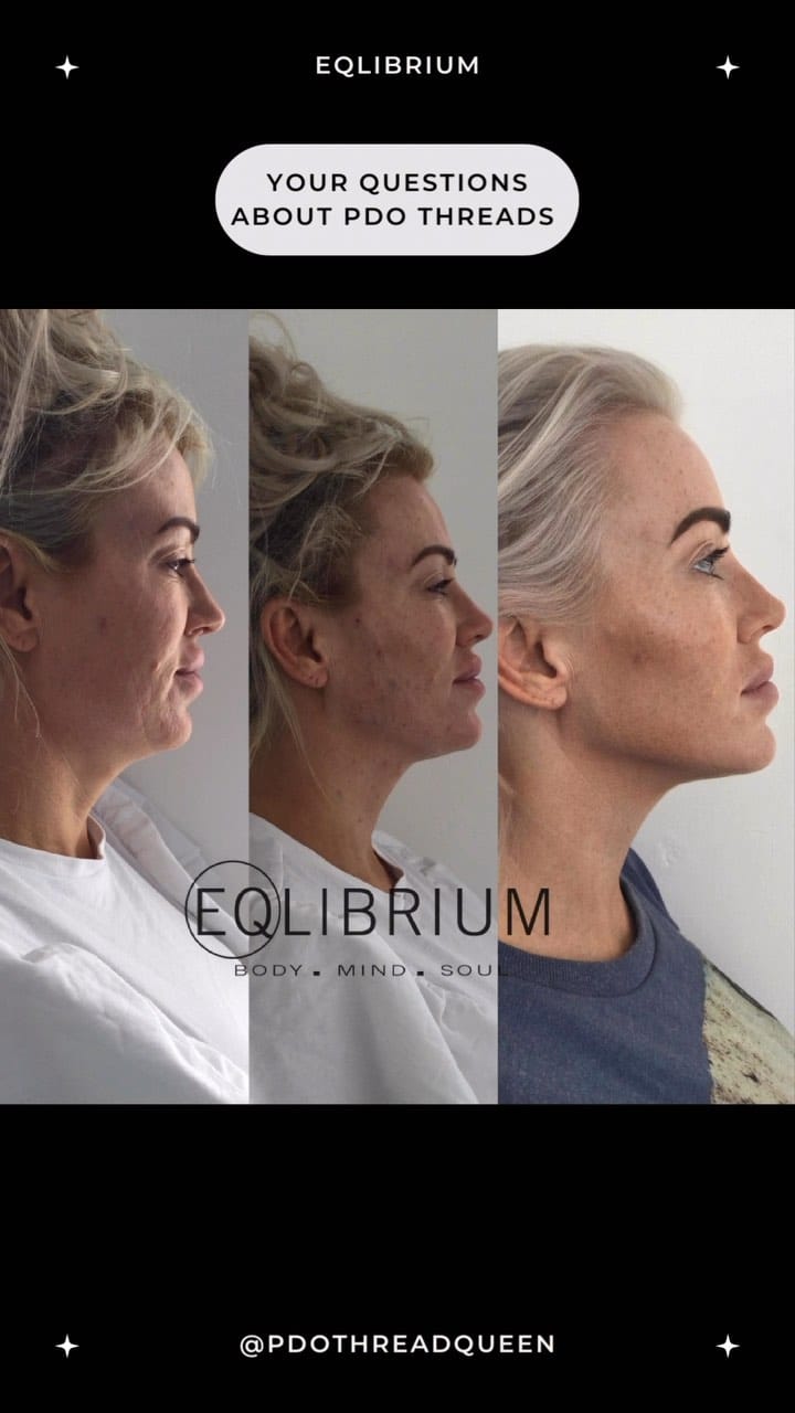 Post 8 by EQlibrium Clinic PDO thread & aesthetics on Instagram (video)
