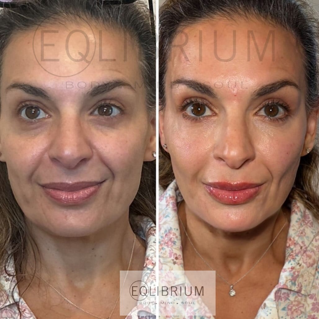 Post 1 by EQlibrium Clinic PDO thread & aesthetics on Instagram (image)