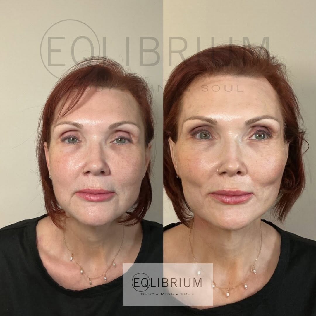 Post 7 by EQlibrium Clinic PDO thread & aesthetics on Instagram (image)