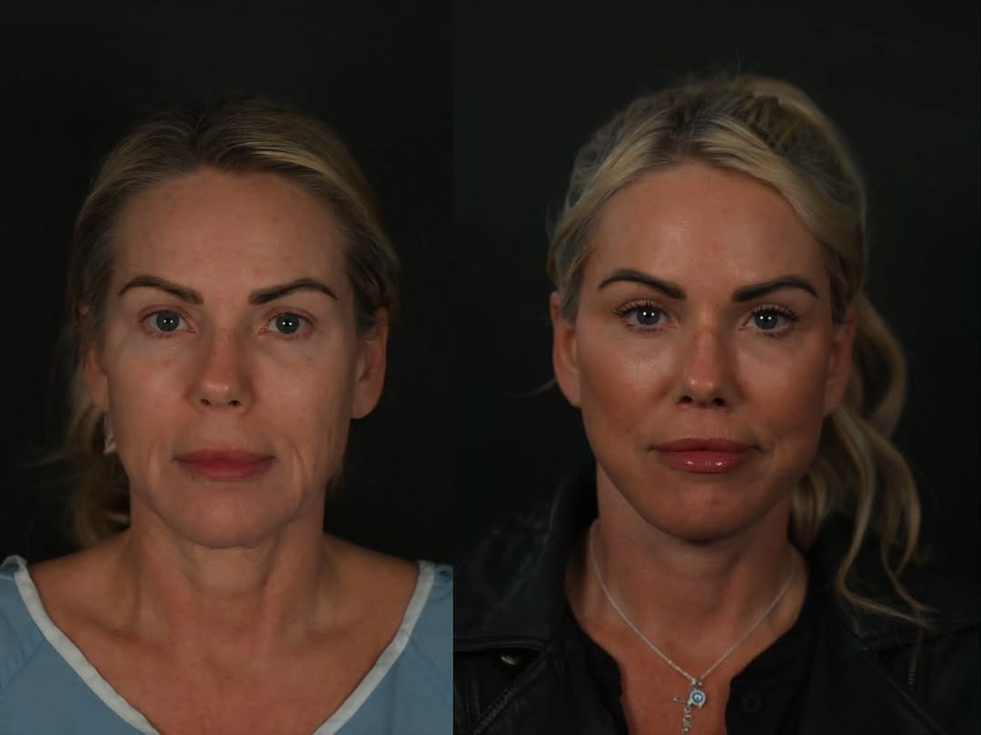 Post 8 by Mike Roskies, MD | Deep Plane Facelift Toronto on Instagram (carousel)