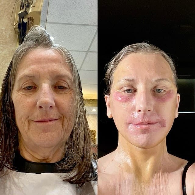Post 9 by Mike Roskies, MD | Deep Plane Facelift Toronto on Instagram (image)