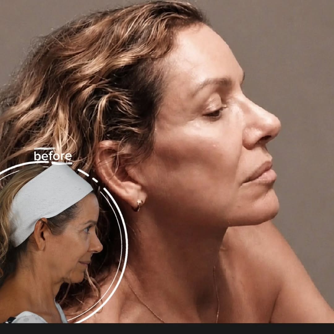 Post 4 by Mike Roskies, MD | Deep Plane Facelift Toronto on Instagram (image)