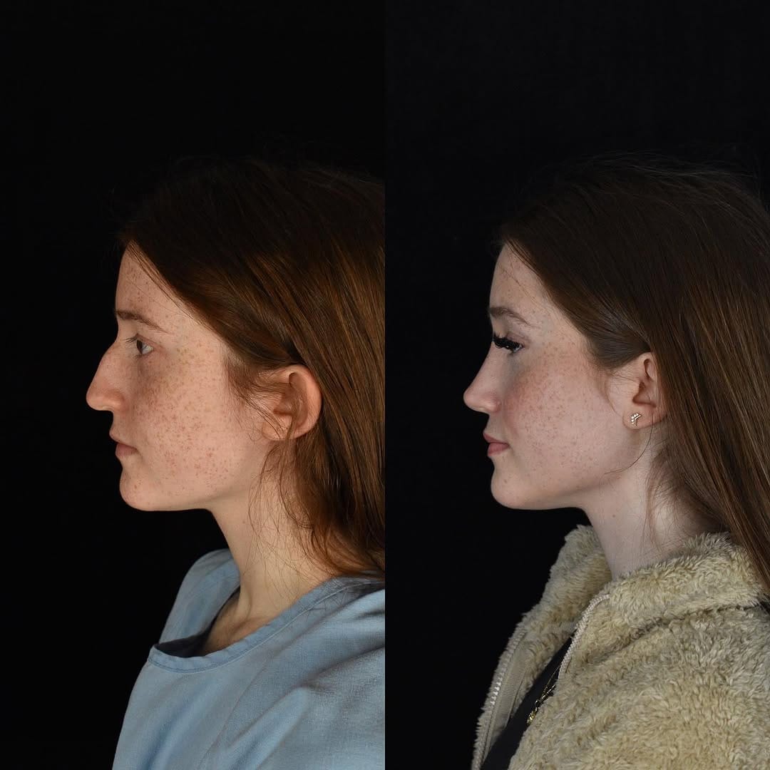 Post 10 by Mike Roskies, MD | Deep Plane Facelift Toronto on Instagram (carousel)