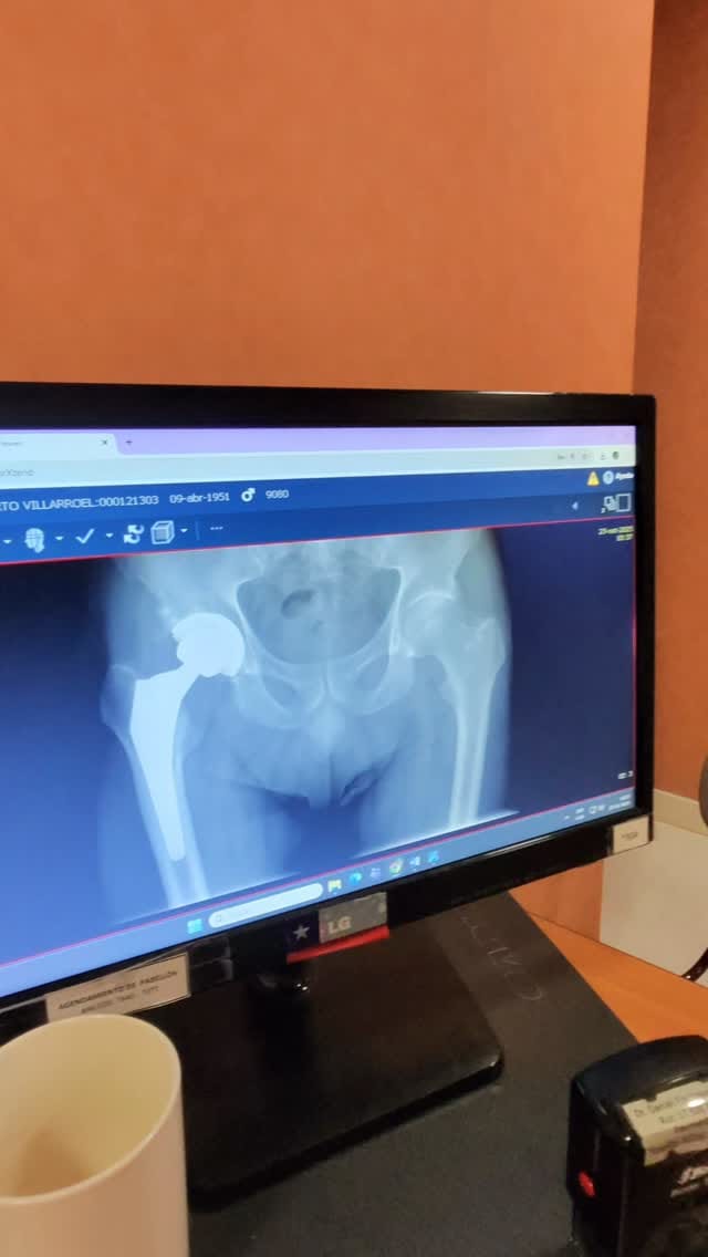 Post 10 by Dr. Daniel Fischman (Cadera) on Instagram (video)