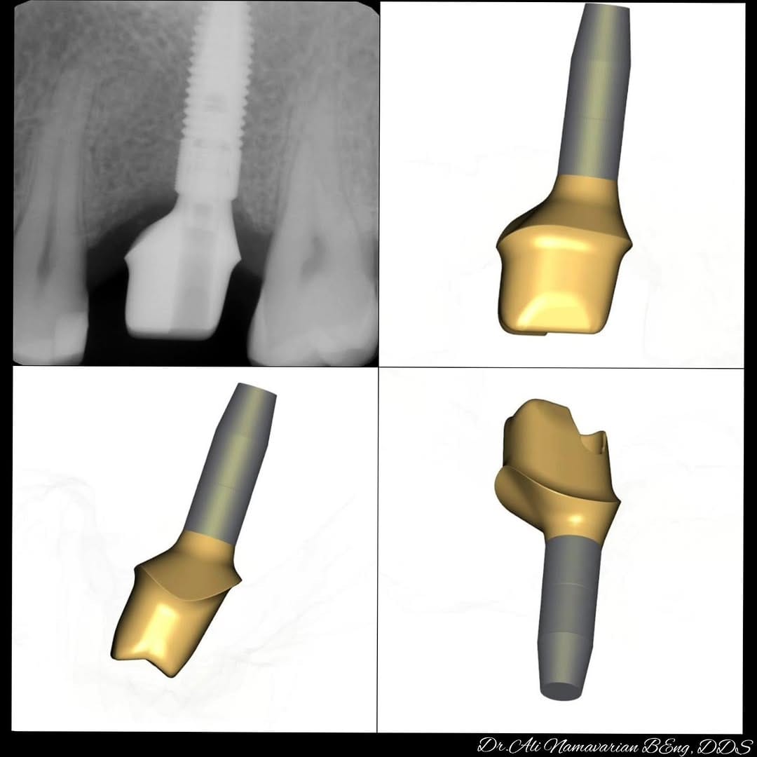 Post 5 by Dr.Ali Namavarian 🇨🇦 Mydent Implant clinic on Instagram (carousel)