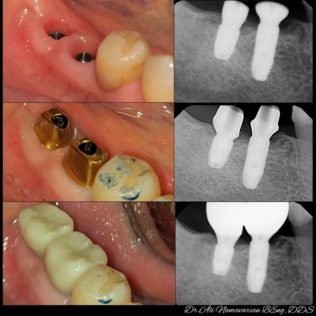 Post 2 by Dr.Ali Namavarian 🇨🇦 Mydent Implant clinic on Instagram (carousel)