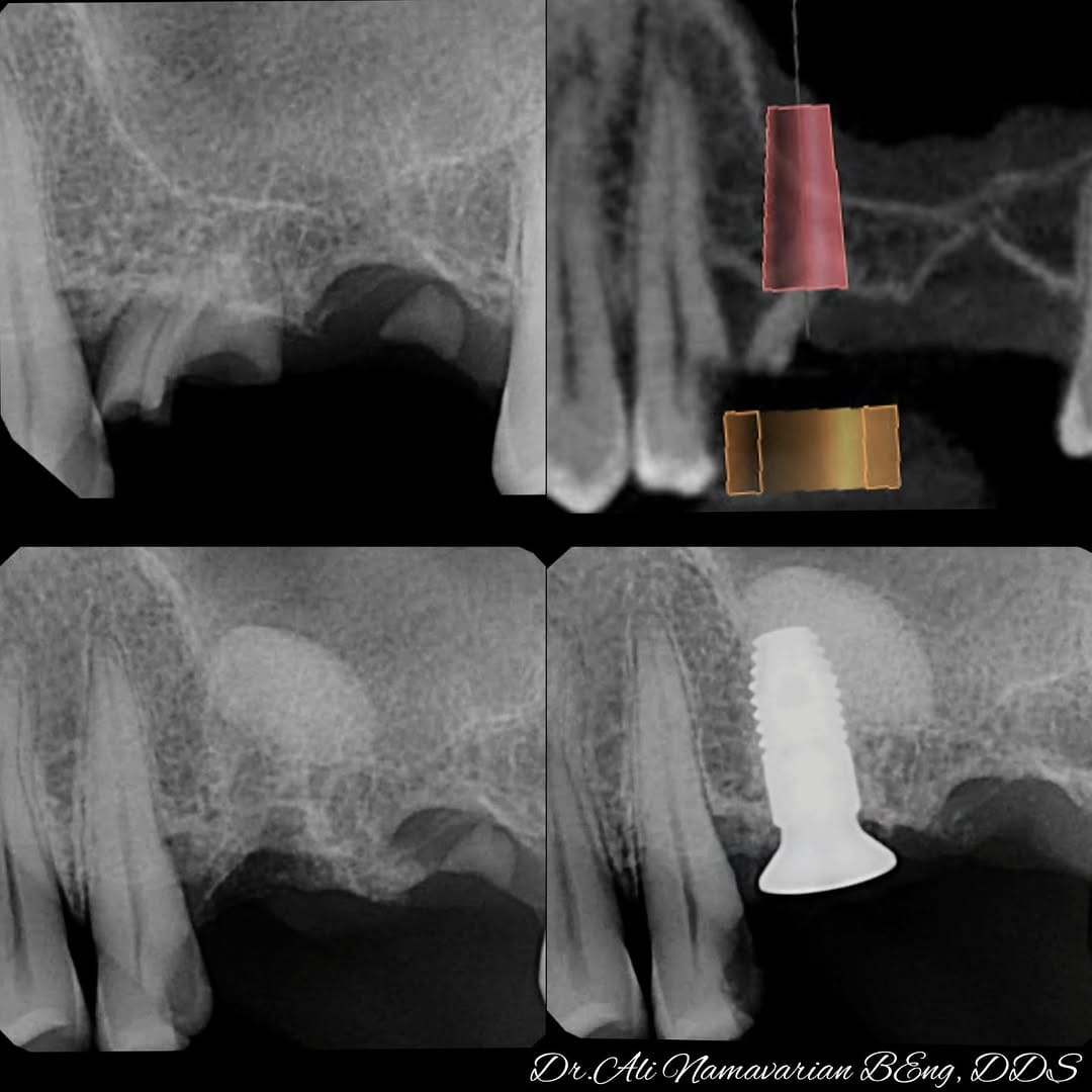 Post 8 by Dr.Ali Namavarian 🇨🇦 Mydent Implant clinic on Instagram (carousel)