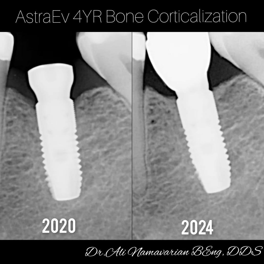 Post 6 by Dr.Ali Namavarian 🇨🇦 Mydent Implant clinic on Instagram (carousel)