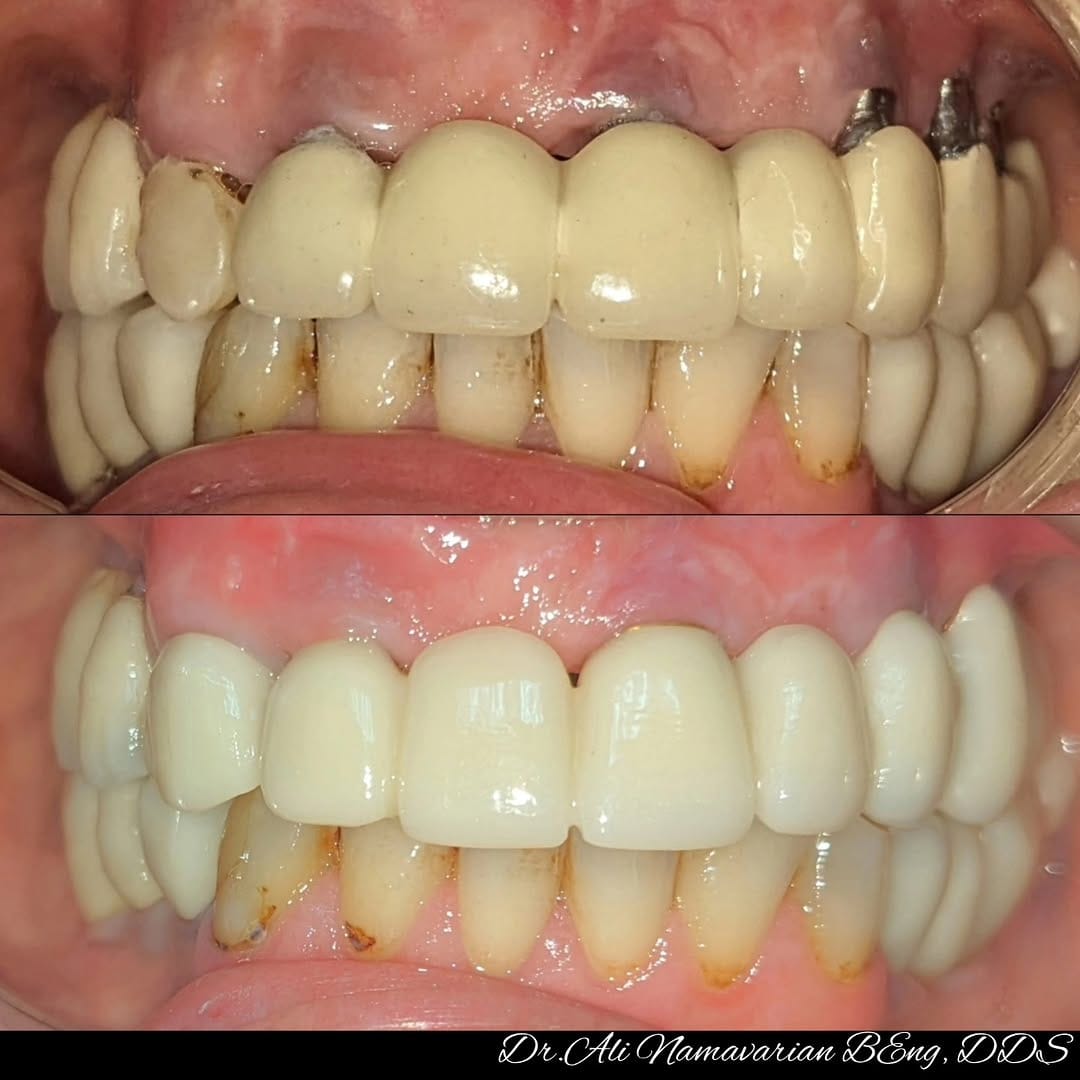 Post 4 by Dr.Ali Namavarian 🇨🇦 Mydent Implant clinic on Instagram (carousel)