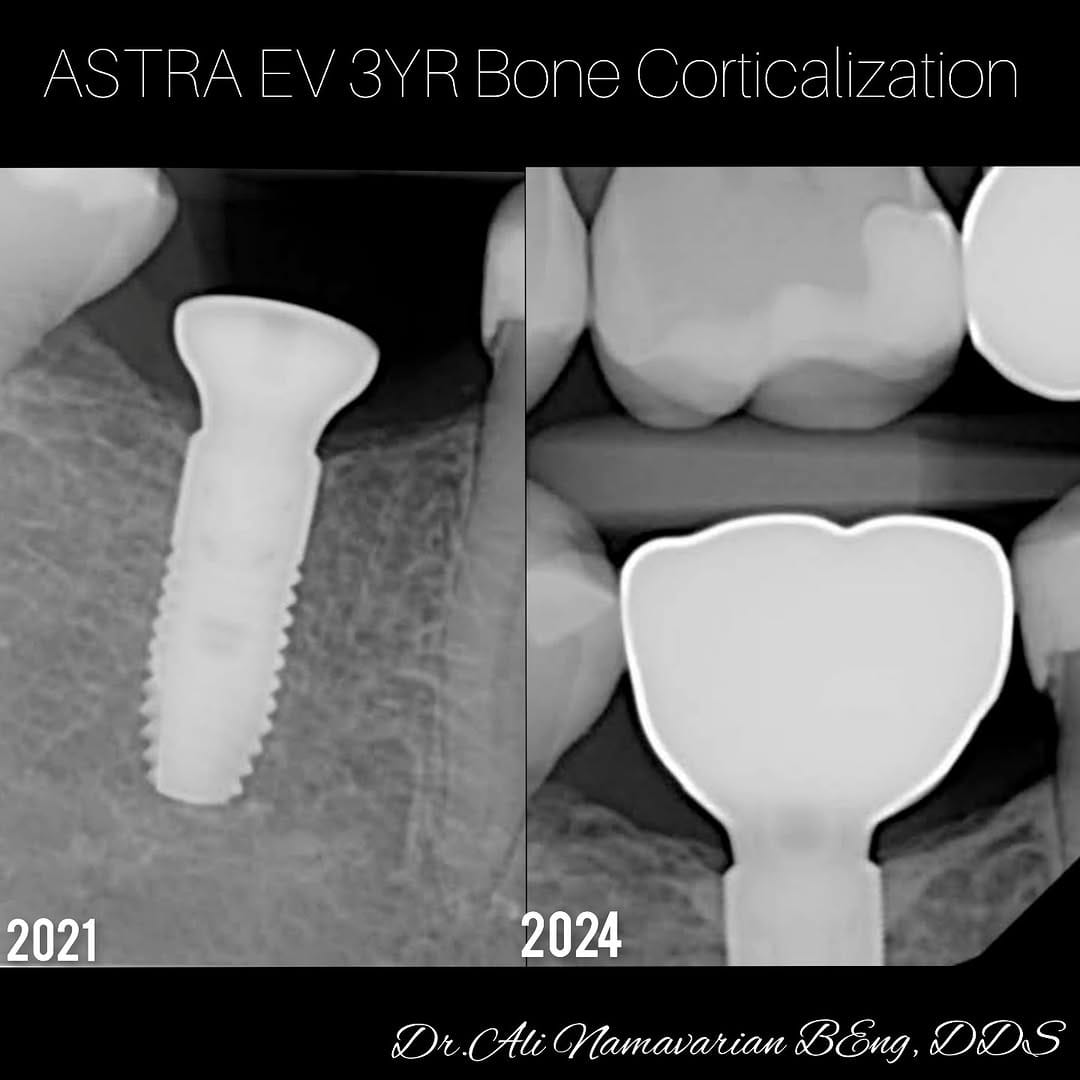 Post 7 by Dr.Ali Namavarian 🇨🇦 Mydent Implant clinic on Instagram (image)