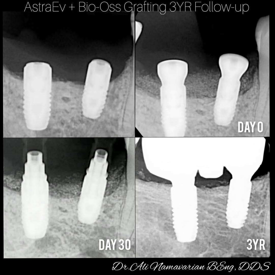 Post 10 by Dr.Ali Namavarian 🇨🇦 Mydent Implant clinic on Instagram (carousel)