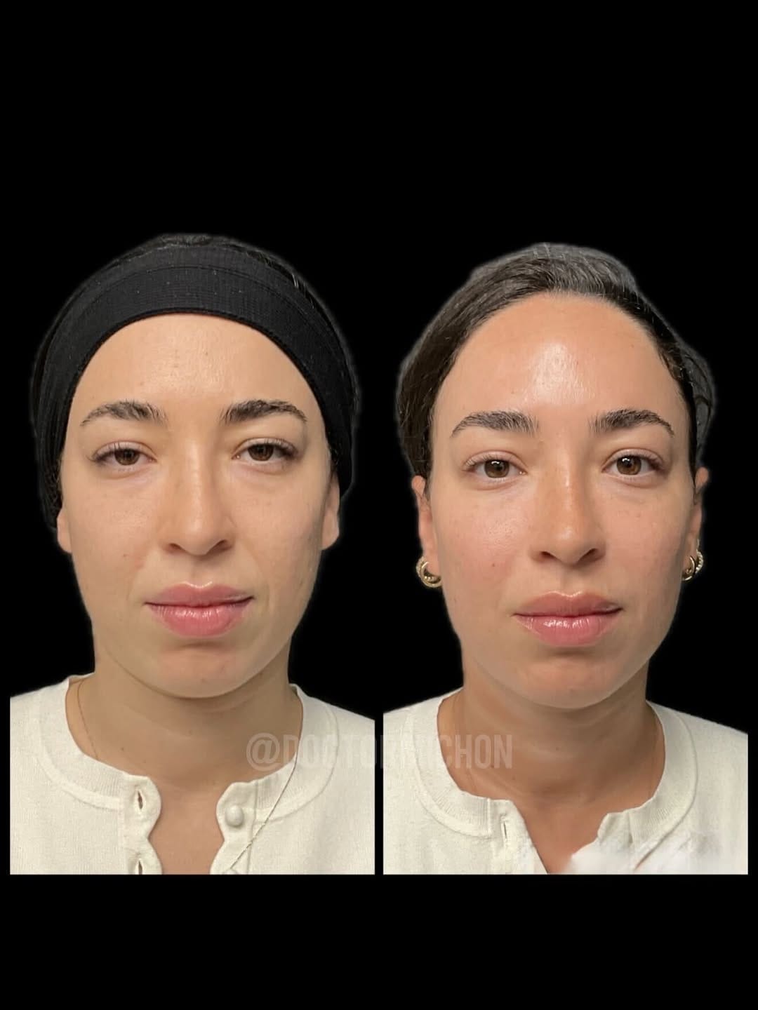 Post 1 by Dr Alain Michon, MD, MSc, PG Dip. Clinical Dermatology on Instagram (carousel)