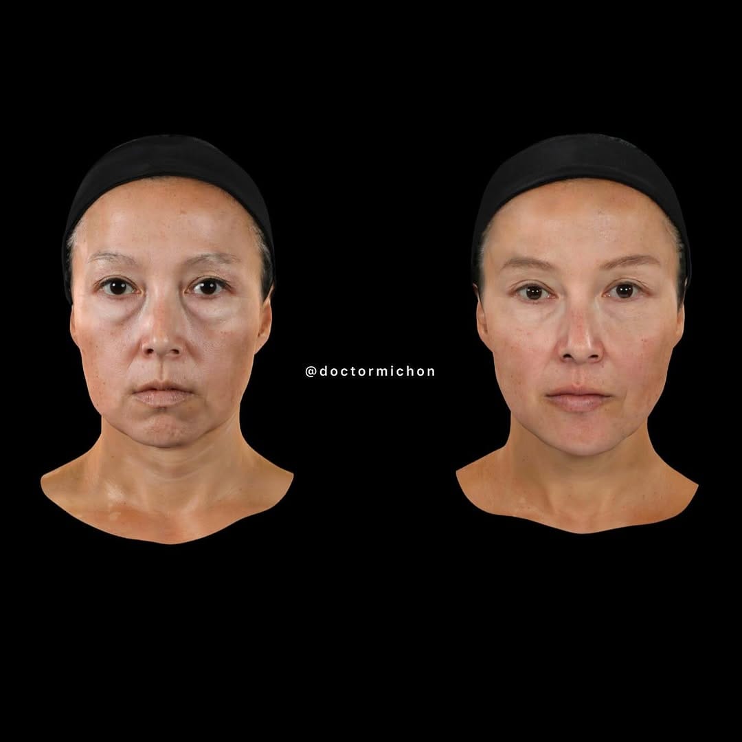 Post 9 by Dr Alain Michon, MD, MSc, PG Dip. Clinical Dermatology on Instagram (carousel)