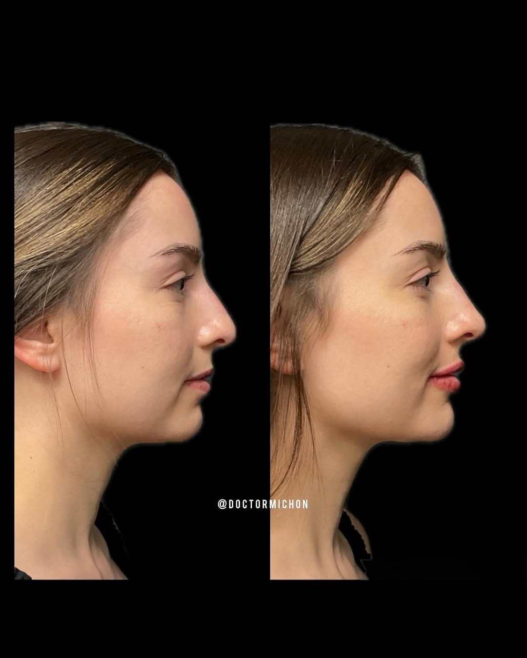 Post 8 by Dr Alain Michon, MD, MSc, PG Dip. Clinical Dermatology on Instagram (carousel)
