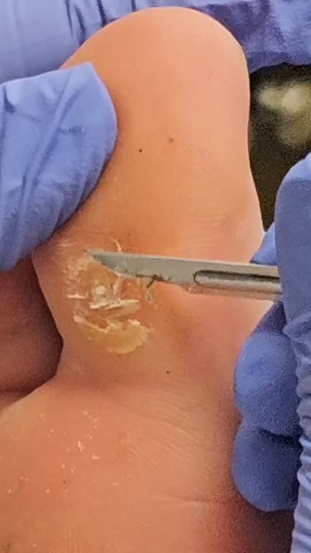 Post 4 by Feet First Clinic on Instagram (video)