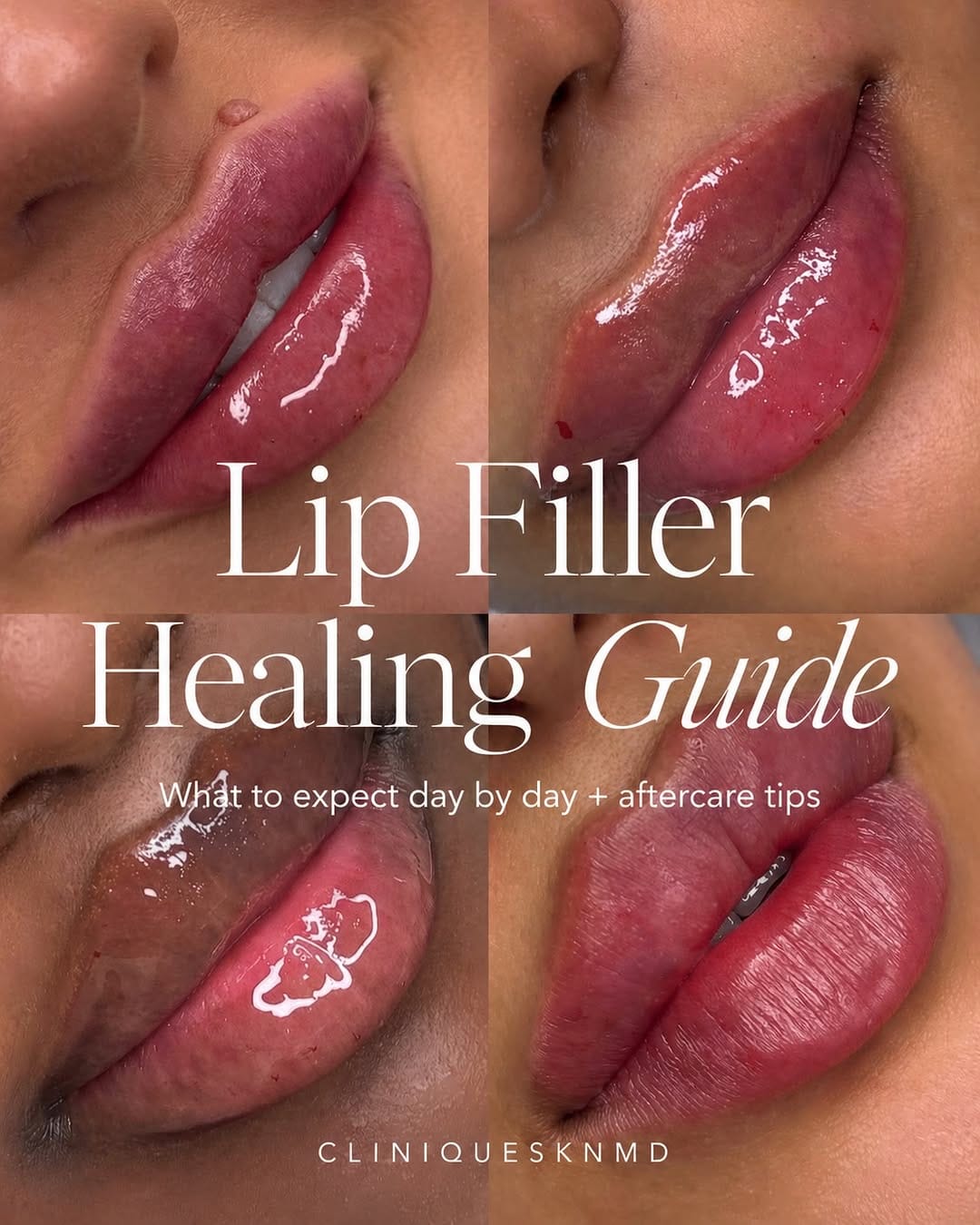 Post 4 by 𝐂𝐋𝐈𝐍𝐈𝐐𝐔𝐄 𝐒𝐊𝐍 𝐌𝐃 - DERMAL FILLERS | BOTOX® on Instagram (carousel)