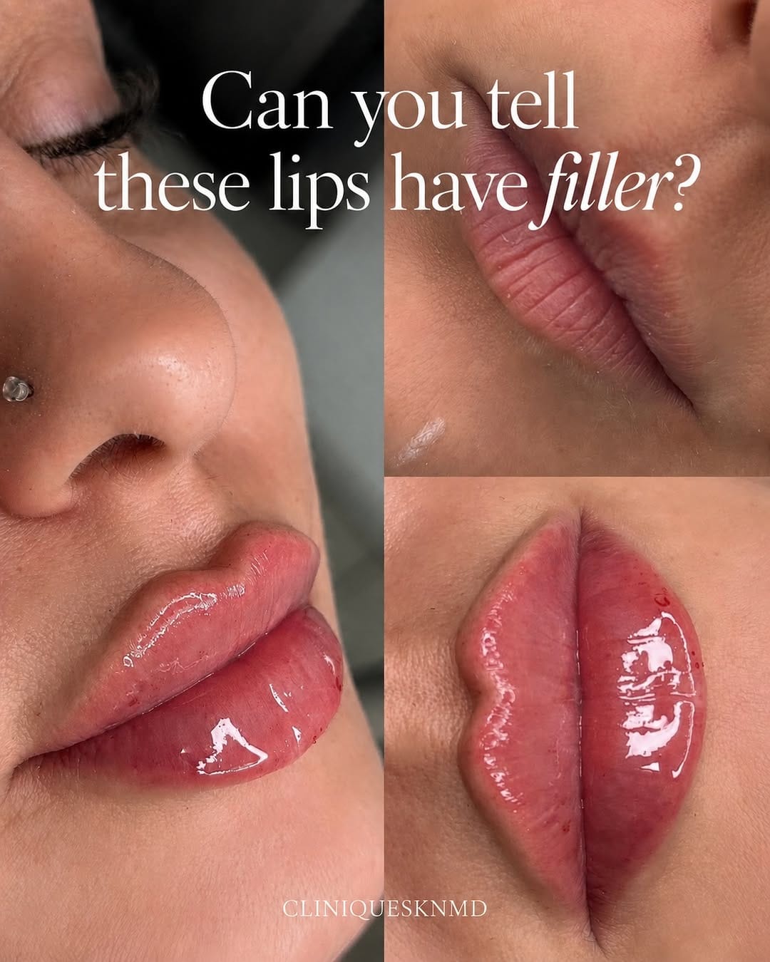 Post 7 by 𝐂𝐋𝐈𝐍𝐈𝐐𝐔𝐄 𝐒𝐊𝐍 𝐌𝐃 - DERMAL FILLERS | BOTOX® on Instagram (carousel)