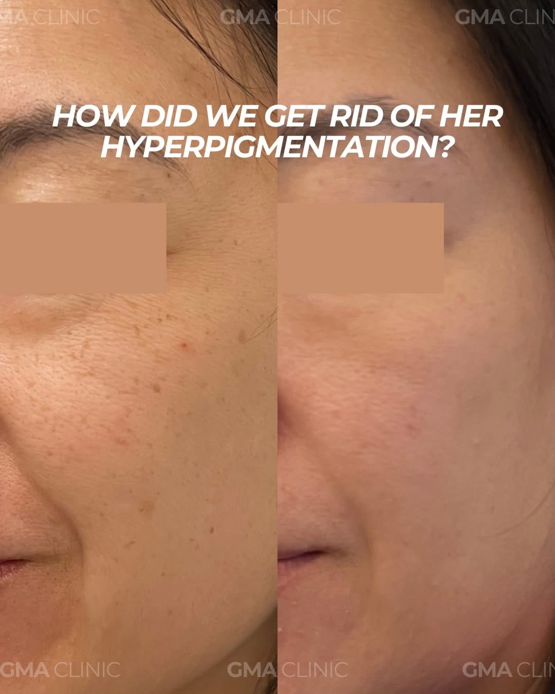 Post 5 by BOTOX | FILLERS | LASER | FACIALS on Instagram (carousel)