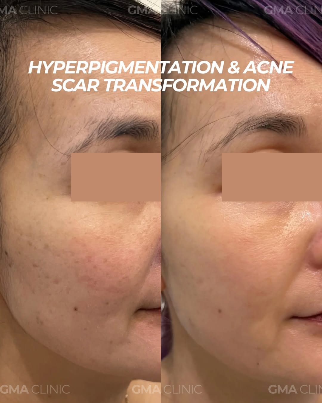 Post 1 by BOTOX | FILLERS | LASER | FACIALS on Instagram (carousel)