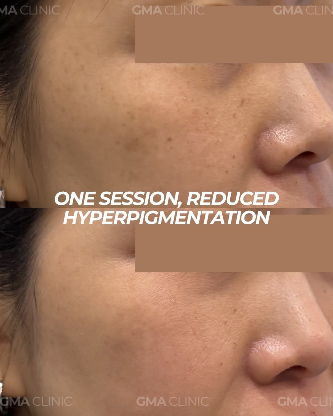 Post 9 by BOTOX | FILLERS | LASER | FACIALS on Instagram (carousel)