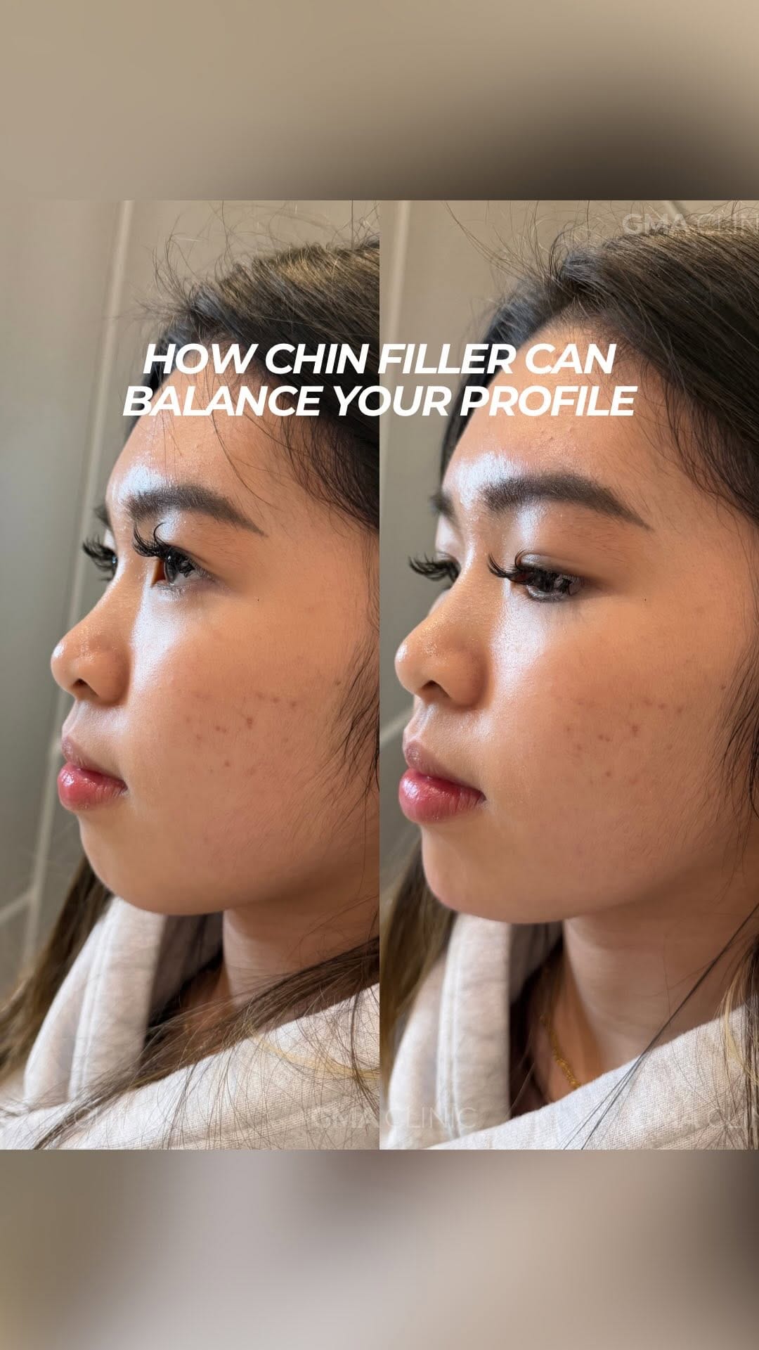 Post 3 by BOTOX | FILLERS | LASER | FACIALS on Instagram (video)