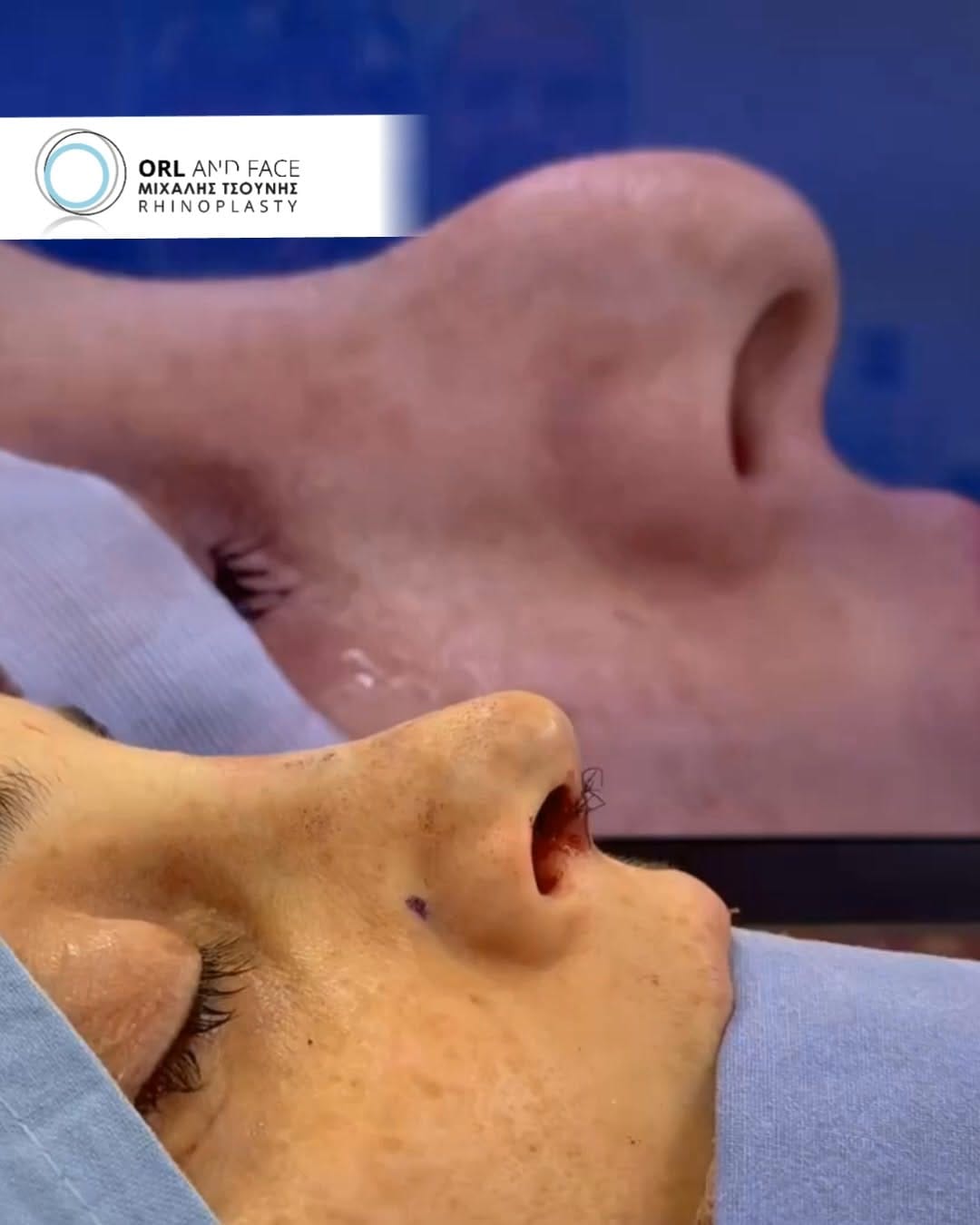 Post 5 by ΩΡΛ Μιχάλης Τσούνης MD, PhD on Instagram (video)