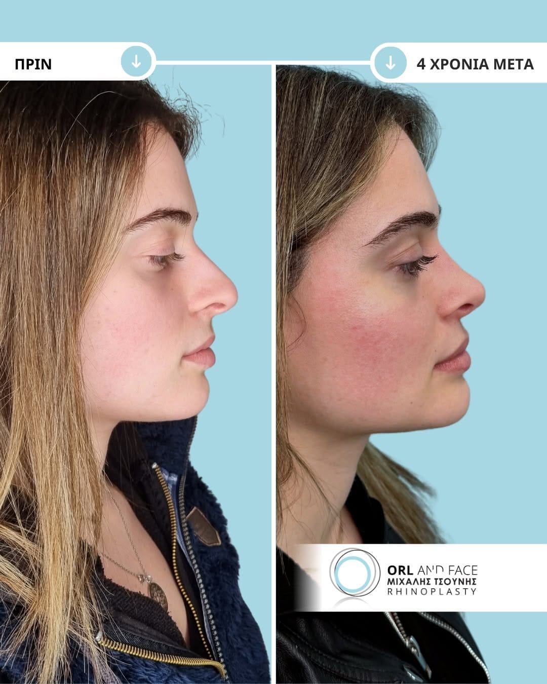 Post 6 by ΩΡΛ Μιχάλης Τσούνης MD, PhD on Instagram (carousel)