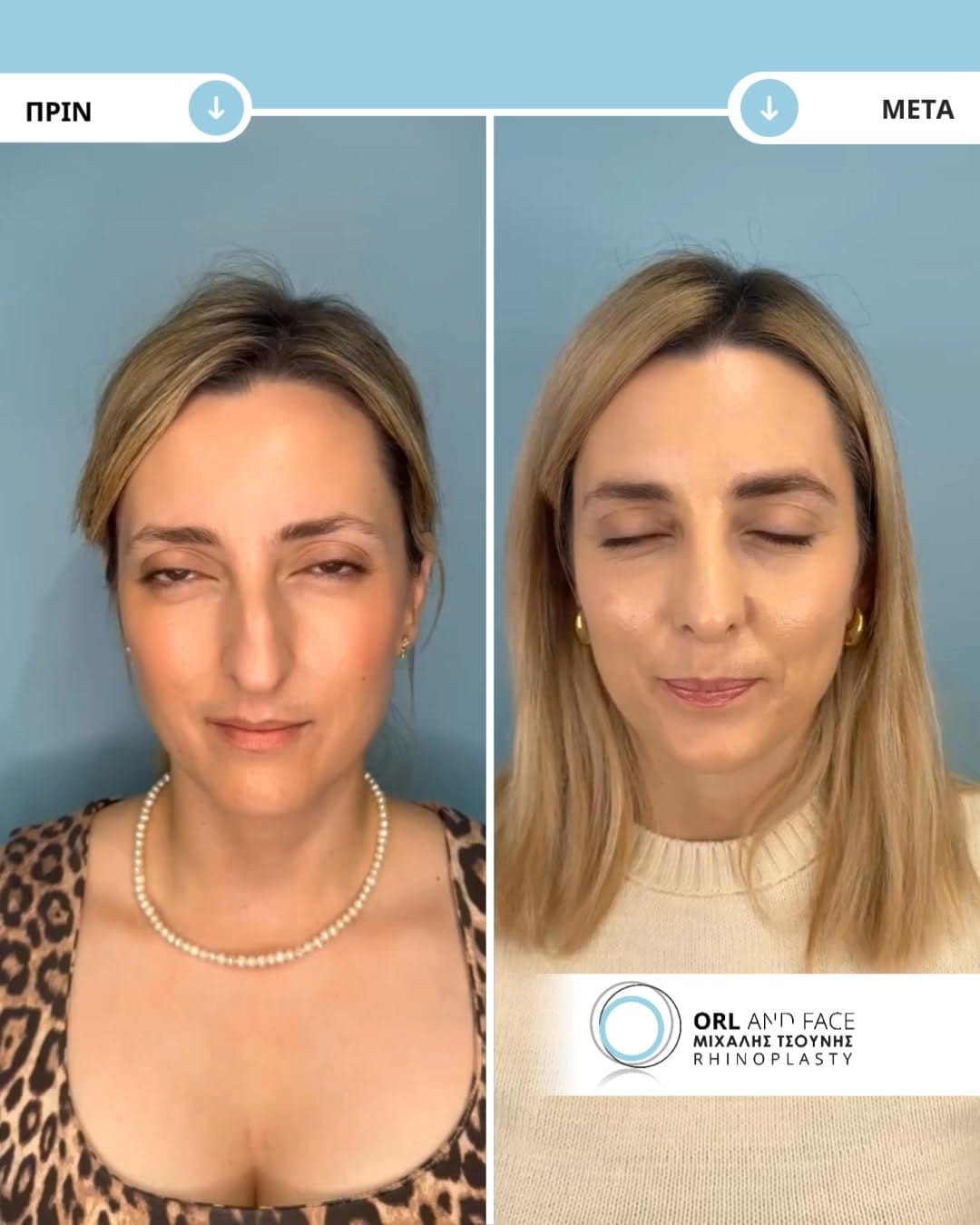 Post 1 by ΩΡΛ Μιχάλης Τσούνης MD, PhD on Instagram (video)