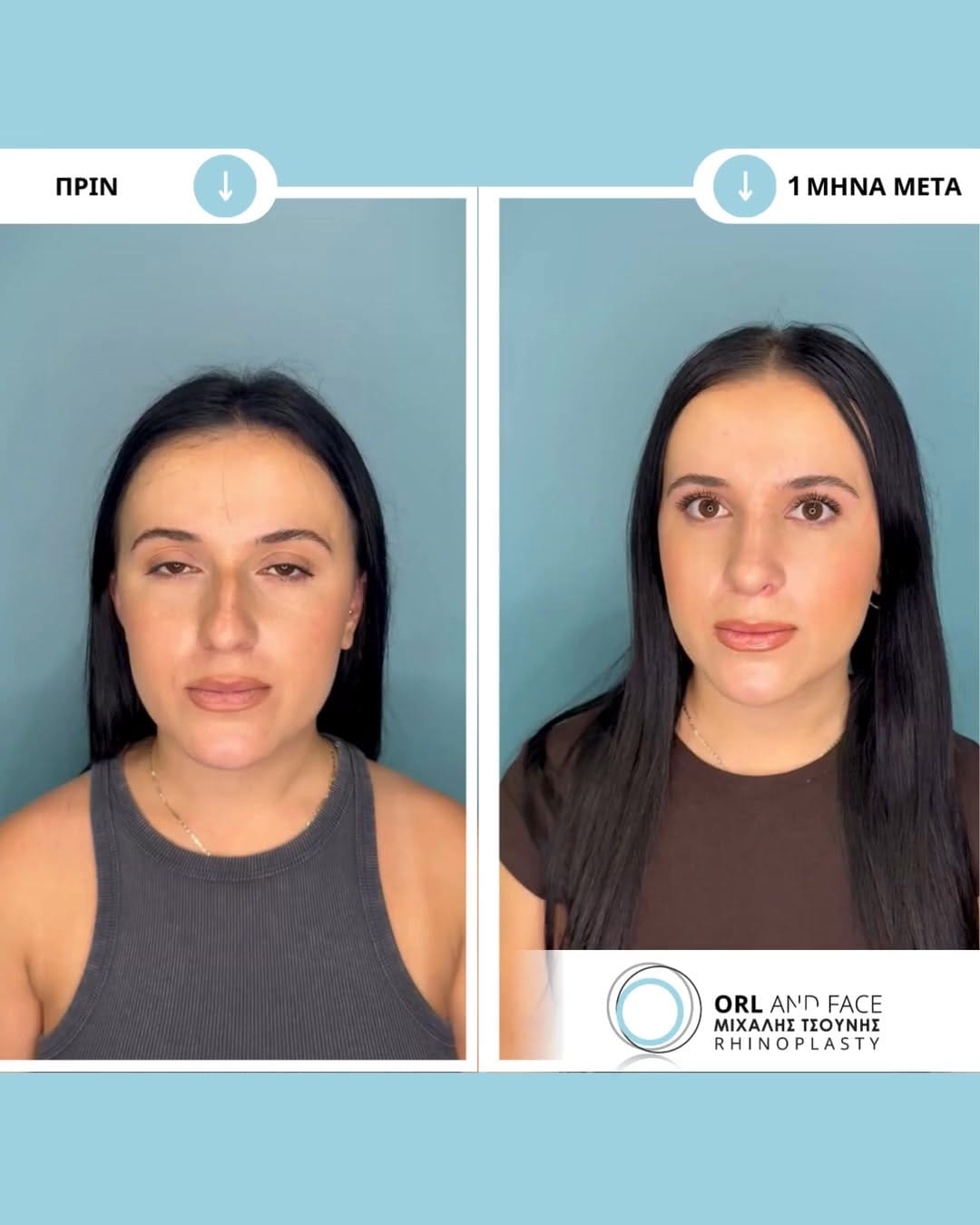 Post 8 by ΩΡΛ Μιχάλης Τσούνης MD, PhD on Instagram (video)