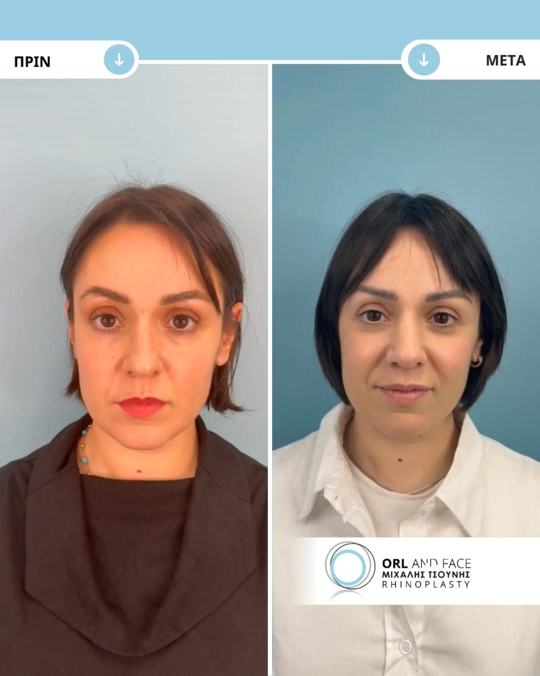 Post 4 by ΩΡΛ Μιχάλης Τσούνης MD, PhD on Instagram (video)
