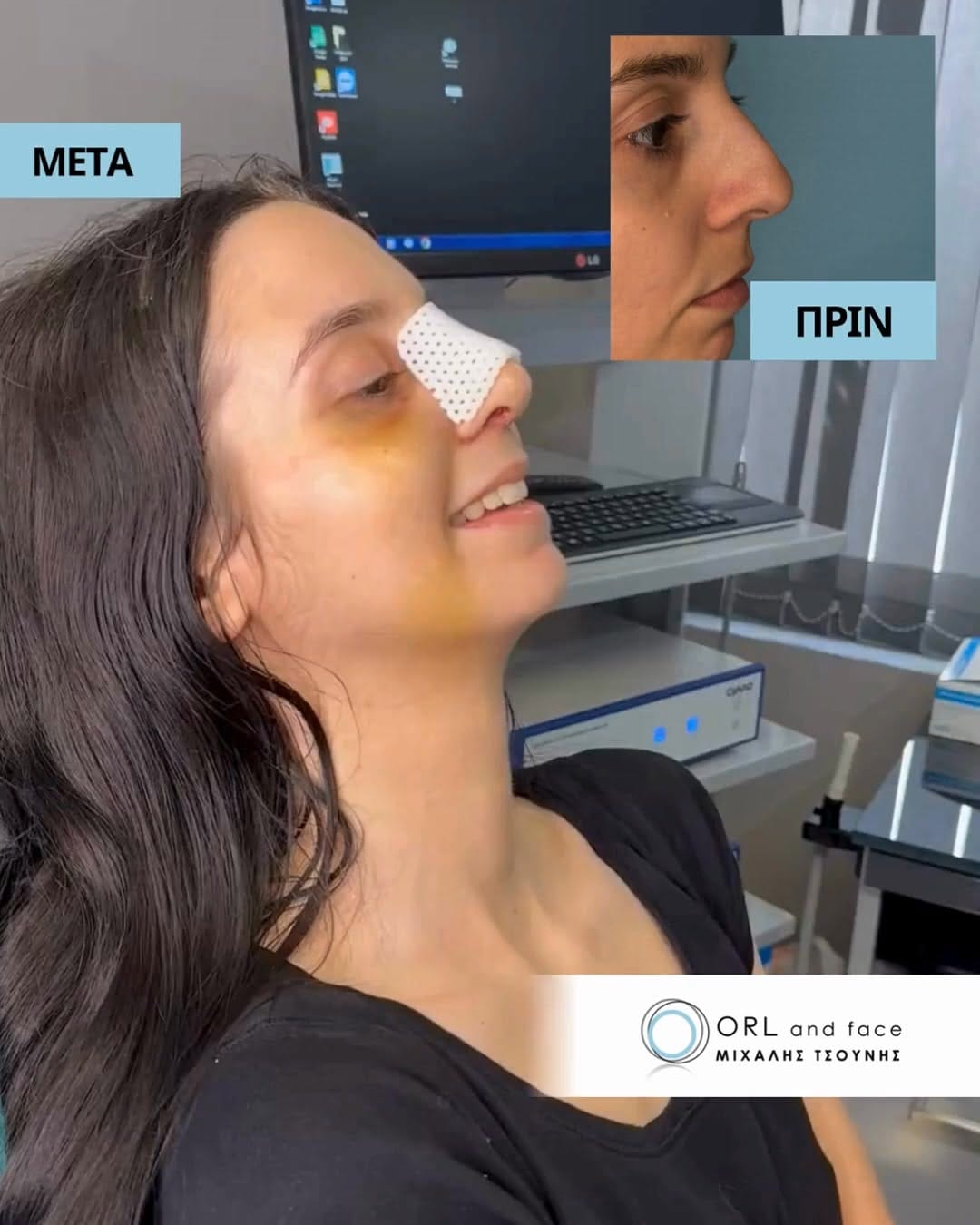 Post 2 by ΩΡΛ Μιχάλης Τσούνης MD, PhD on Instagram (video)