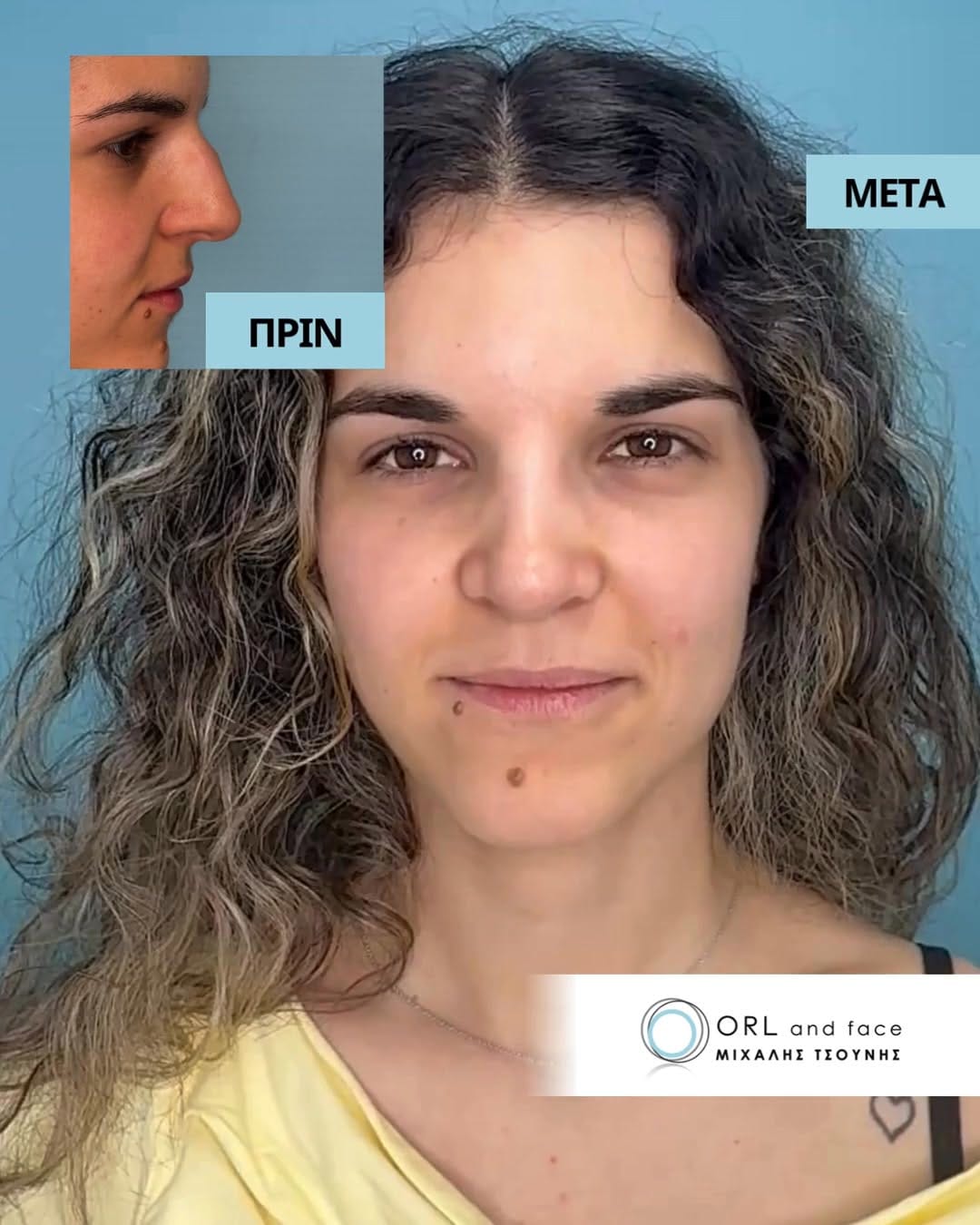 Post 3 by ΩΡΛ Μιχάλης Τσούνης MD, PhD on Instagram (video)