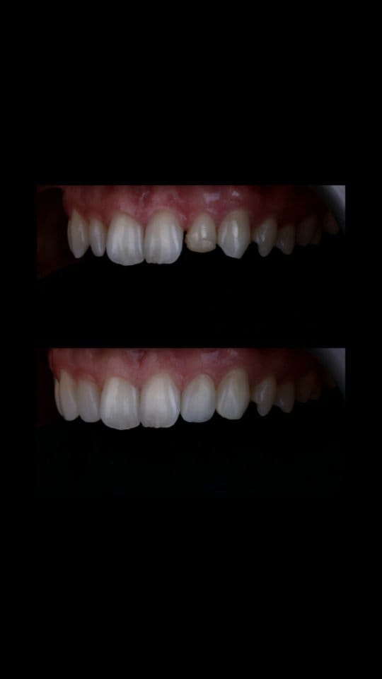 Post 4 by Composite bonding | Veneers on Instagram (video)