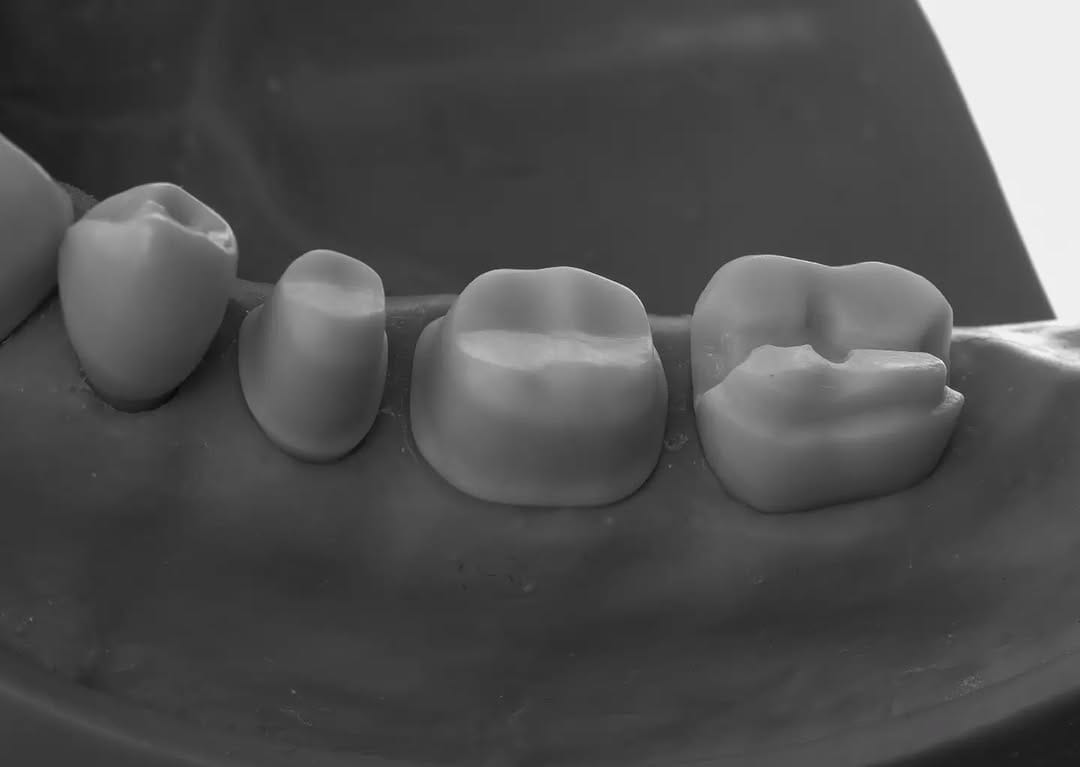 Post 6 by Composite bonding | Veneers on Instagram (carousel)