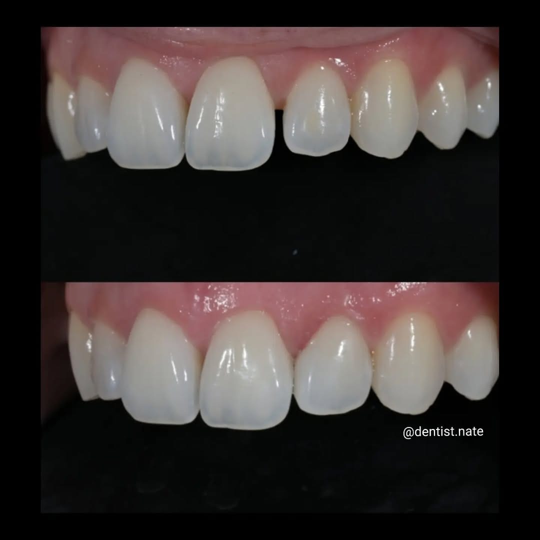 Post 5 by Composite bonding | Veneers on Instagram (image)