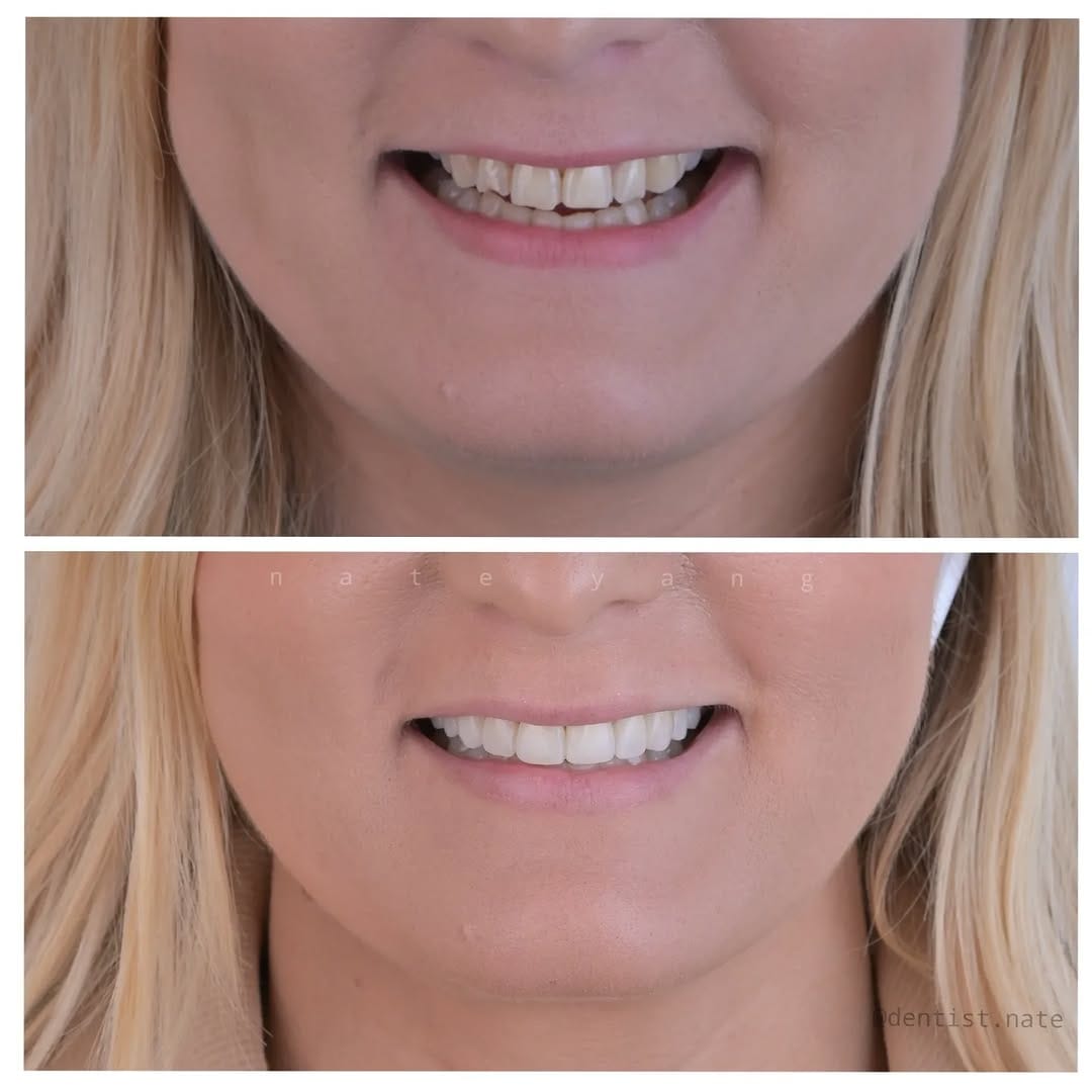 Post 3 by Composite bonding | Veneers on Instagram (image)