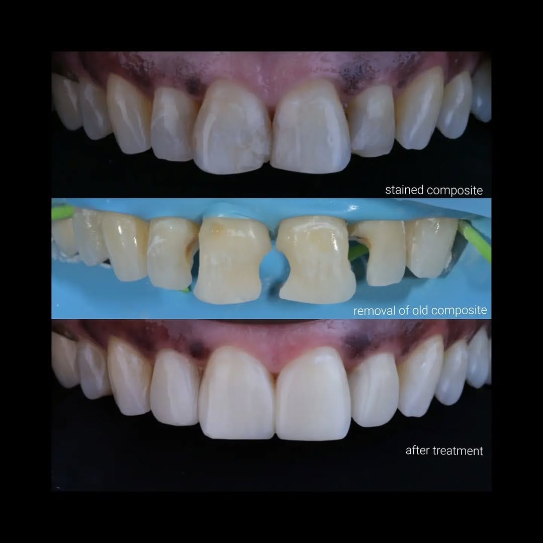 Post 9 by Composite bonding | Veneers on Instagram (carousel)