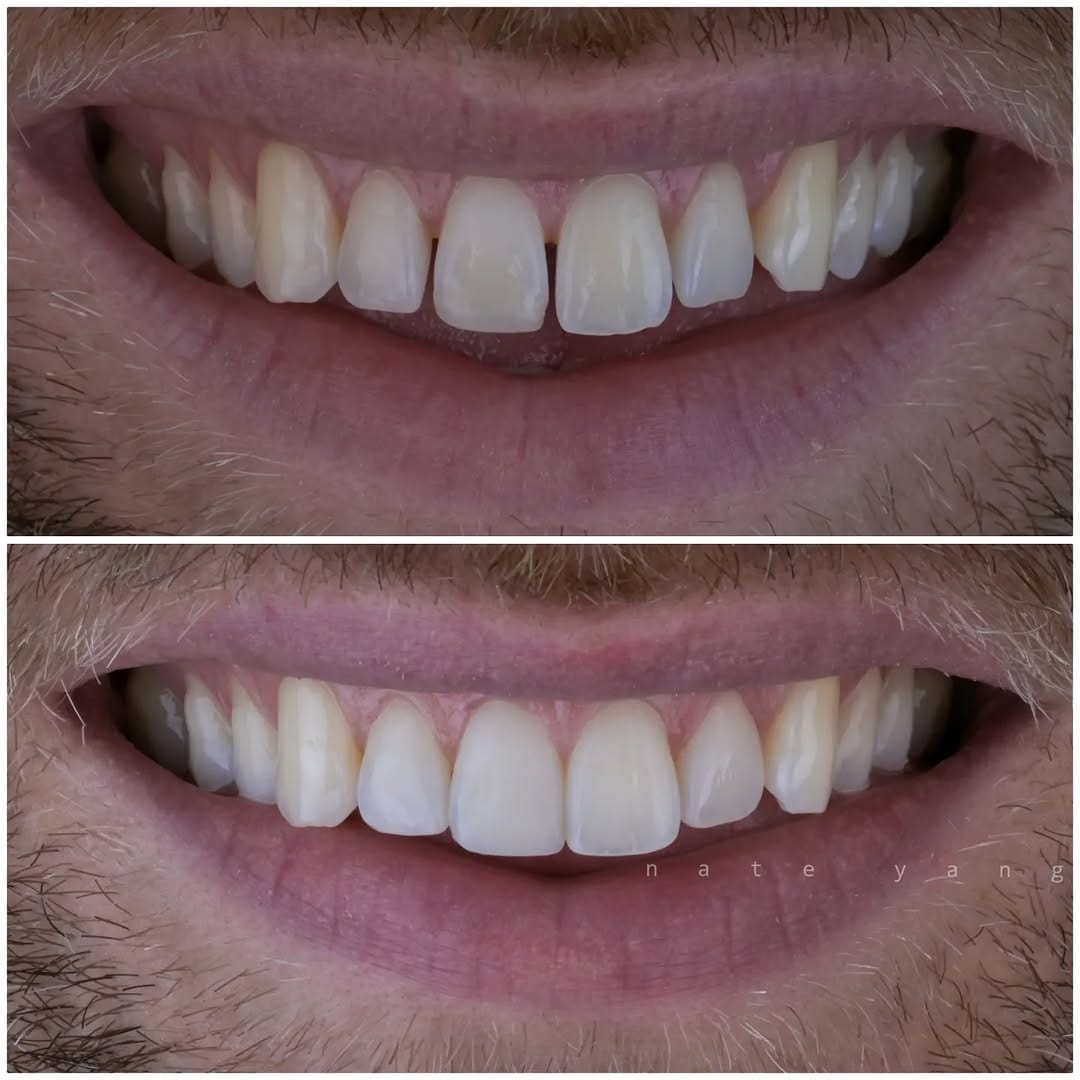 Post 1 by Composite bonding | Veneers on Instagram (carousel)