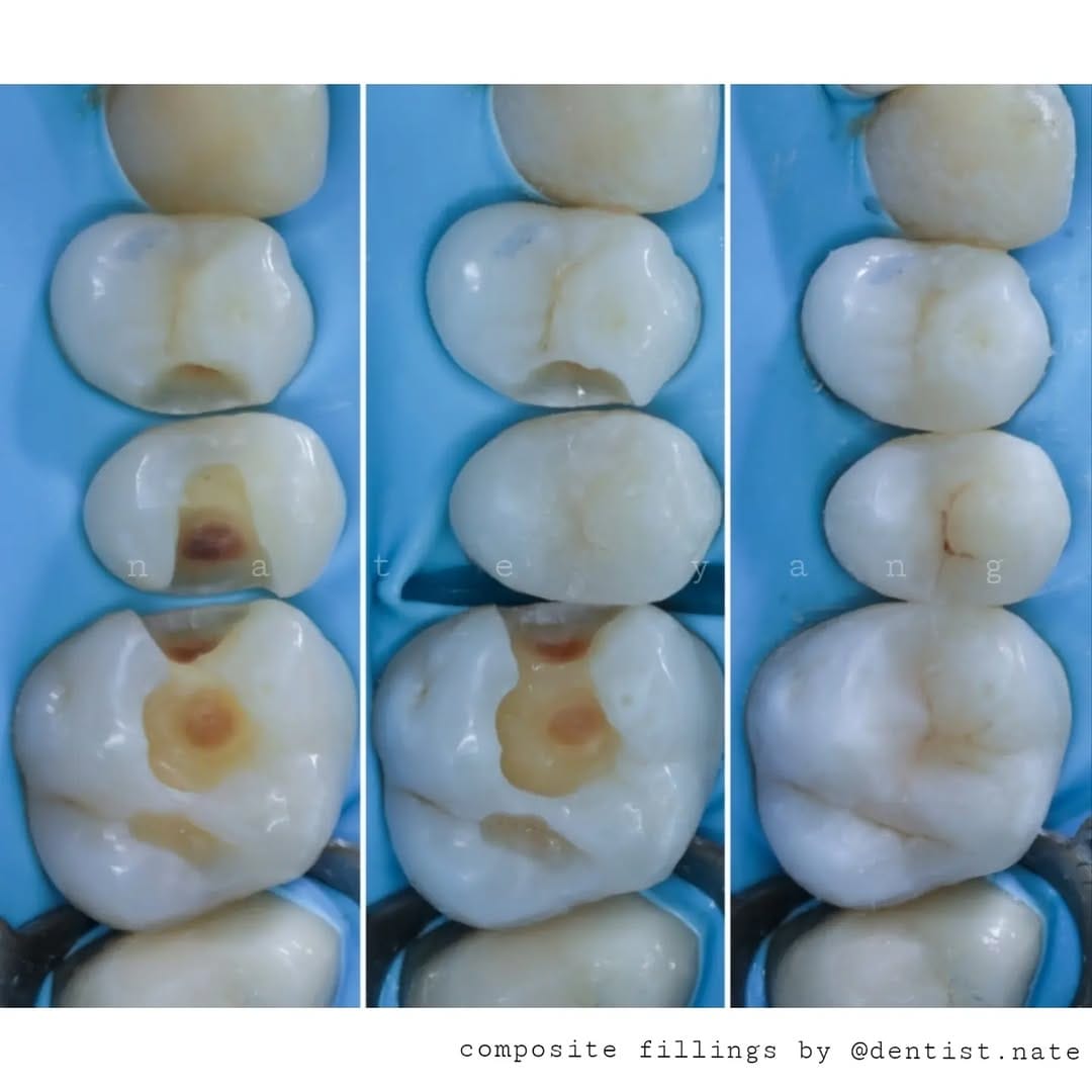 Post 8 by Composite bonding | Veneers on Instagram (image)
