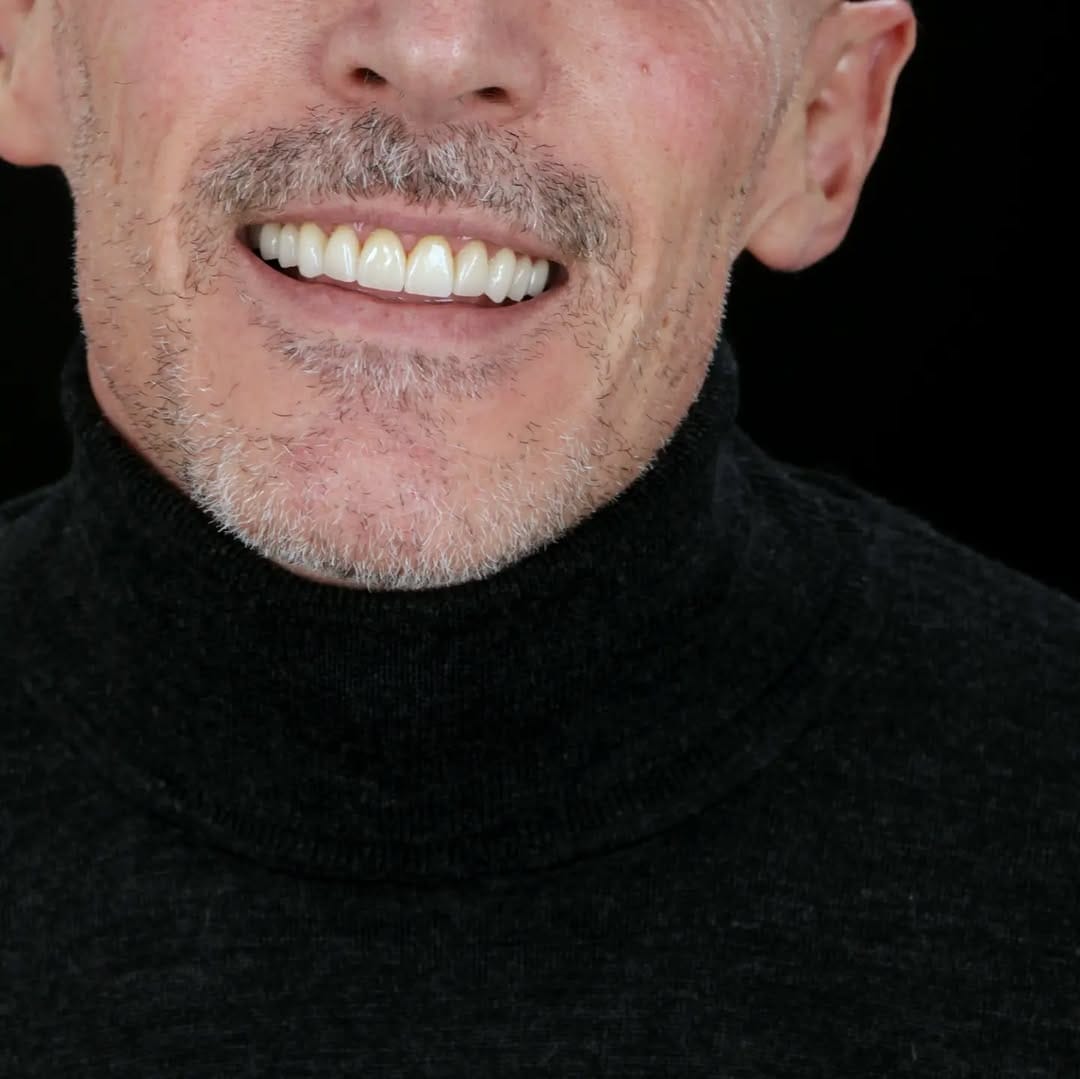 Post 2 by Composite bonding | Veneers on Instagram (carousel)
